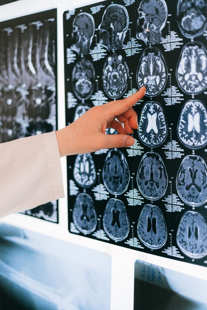 Exames que detectam o Alzheimer antes dos sintomas post 7